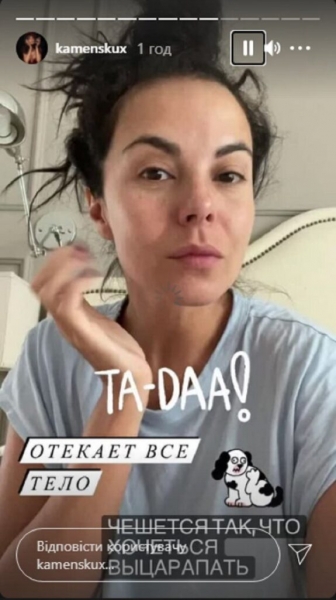 Настя Каменских показала последствия сильной аллергии